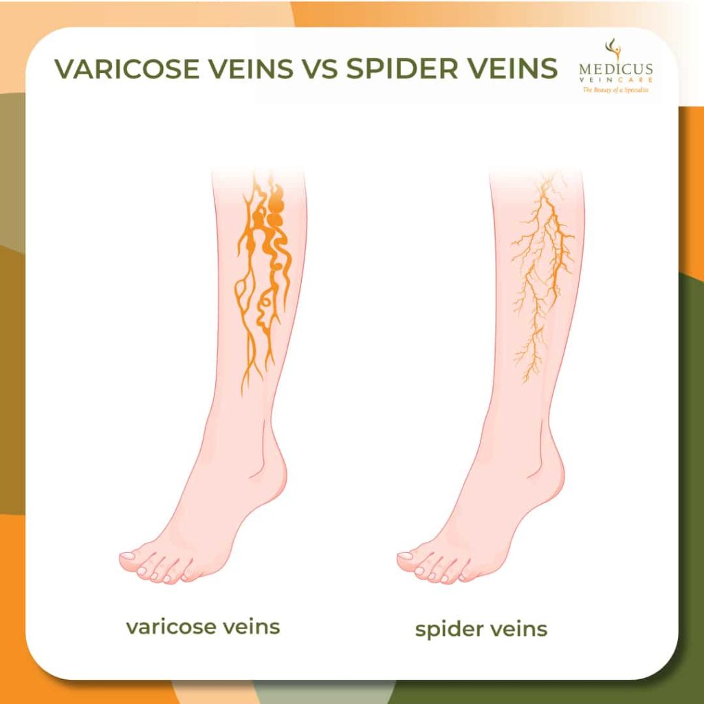 Similarities And Differences Of Spider And Varicose Veins Medicus